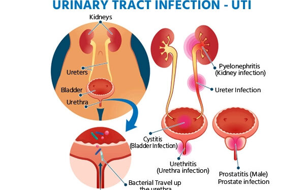 मूत्रमार्गाचा संसर्ग होऊ शकतो, जाणून घ्या लक्षणे…