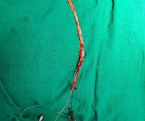 वीस वर्षांपासून “व्हेरिकोज व्हेन्स”ची दुखरी नस काढून रुग्णाला मिळाला दिलासा