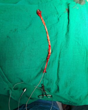 वीस वर्षांपासून “व्हेरिकोज व्हेन्स”ची दुखरी नस काढून रुग्णाला मिळाला दिलासा