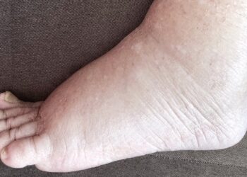 हत्तीरोगबाधित दिव्यांगांना प्रमाणपत्र देण्याची कार्यवाही सुरू