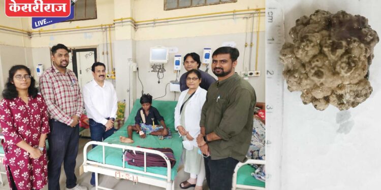 लघवीच्या पिशवीत मुतखडा : जीवघेण्या वेदनांपासून ११ वर्षीय मुलाला दिलासा