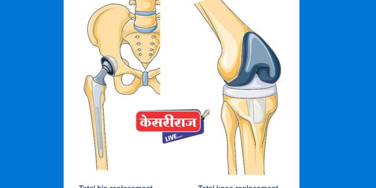 गुडघा अन् खुबा प्रत्यारोपण होणार योजनेंतर्गत मोफत