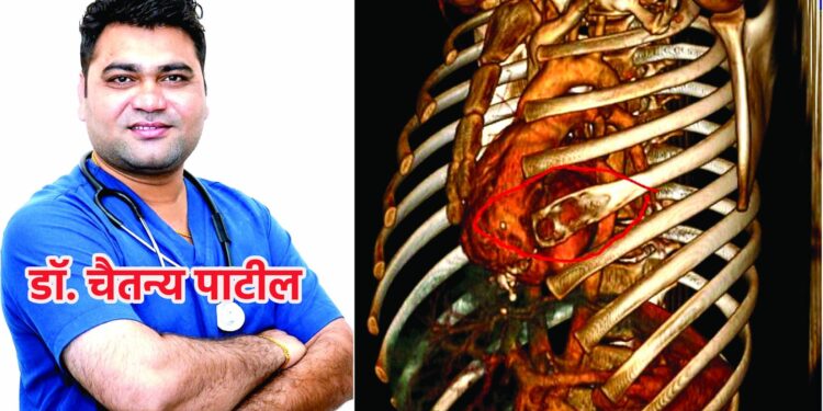 बरगडया फ्रॅक्चर झालेल्या अत्यावस्थ रूग्णावर यशस्वी उपचार