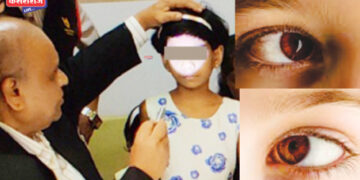 तिरळेपणा शस्त्रक्रियेचे मोफत शिबिर आजपासून तज्ञांची टीम ३ रोजी जळगावात